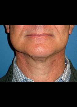 Facelift / Neck Lift Case 8