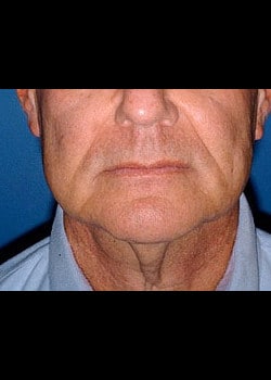 Facelift / Neck Lift Case 8