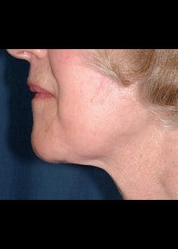 Facelift / Neck Lift Case 10