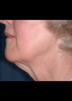 Facelift / Neck Lift Case 10