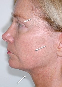 Facelift / Neck Lift Case 12