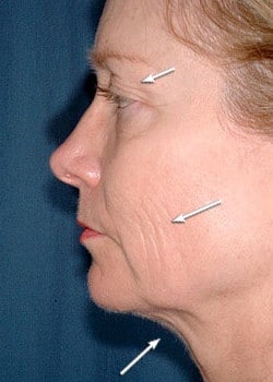 Facelift / Neck Lift Case 12