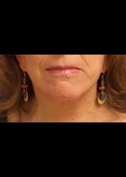 Facelift / Neck Lift Case 14