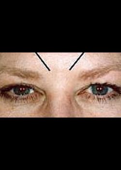 BOTOX® / Dysport® / Xeomin® Case 2
