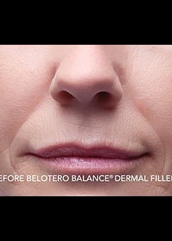 BELOTERO® Case 1