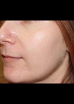 Chemical Peel Case 3