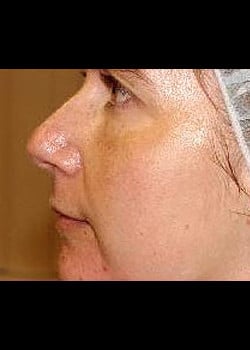 Chemical Peel Case 3