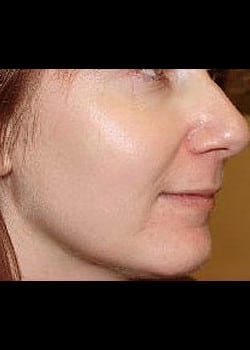 Chemical Peel Case 4