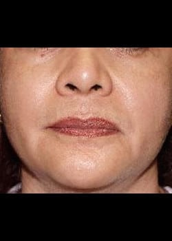 Chemical Peel Case 6