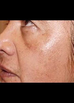 Chemical Peel Case 7