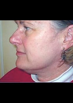 Chemical Peel Case 8