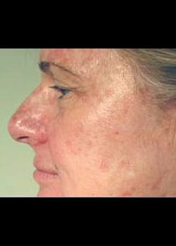 Chemical Peel Case 8