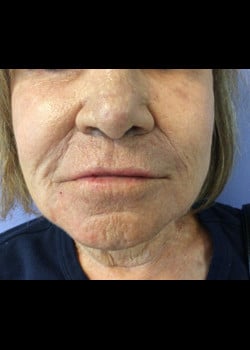 Wrinkle Fillers Case 2