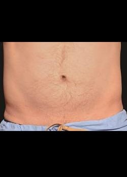 CoolSculpting Case 3