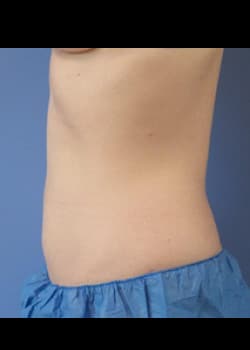 CoolSculpting Case 4