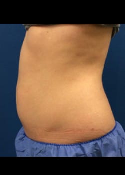 CoolSculpting Case 4