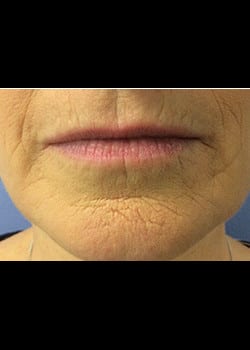 Wrinkle Fillers Case 3