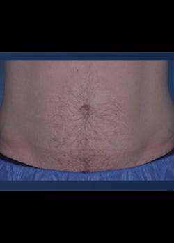 CoolSculpting Case 5