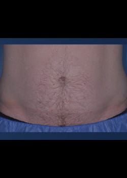 CoolSculpting Case 5