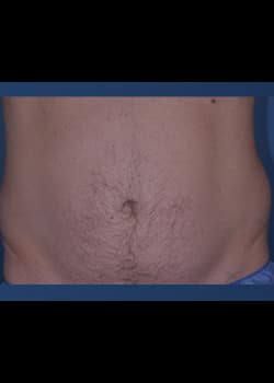 CoolSculpting Case 5