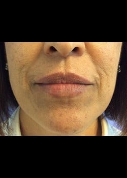 Wrinkle Fillers Case 7