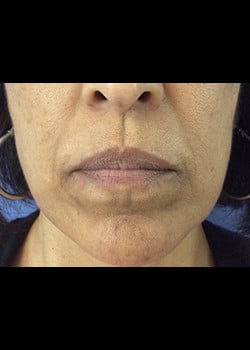 Wrinkle Fillers Case 7