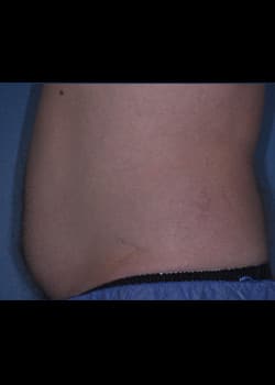 CoolSculpting Case 6