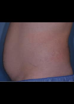 CoolSculpting Case 6