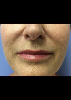 Wrinkle Fillers Case 10