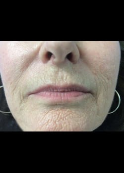 Wrinkle Fillers Case 10