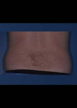 CoolSculpting Case 7