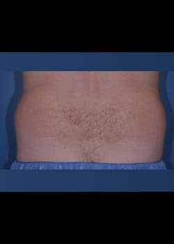 CoolSculpting Case 7