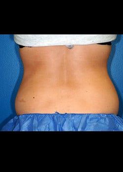 CoolSculpting Case 8