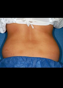 CoolSculpting Case 8