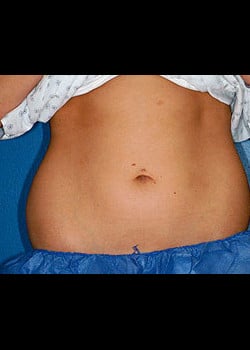 CoolSculpting Case 9