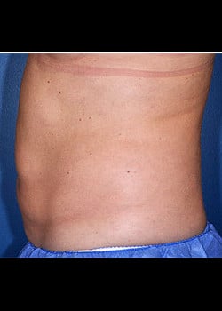 CoolSculpting Case 10