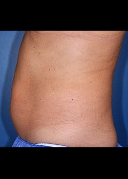 CoolSculpting Case 10