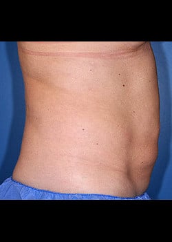 CoolSculpting Case 11