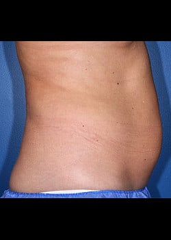 CoolSculpting Case 11