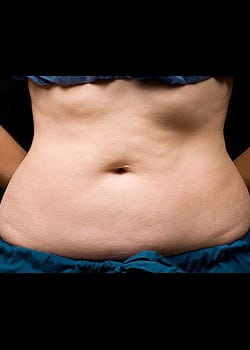 CoolSculpting Case 12