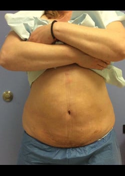 Liposuction Case 2