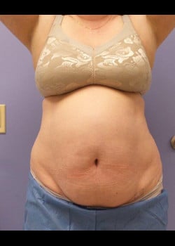 Liposuction Case 2