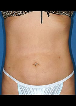 Liposuction Case 6