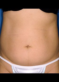 Liposuction Case 6