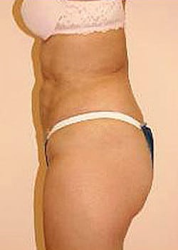 Liposuction Case 8