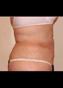 Liposuction Case 9