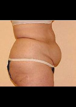 Liposuction Case 9