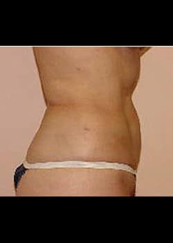 Liposuction Case 10