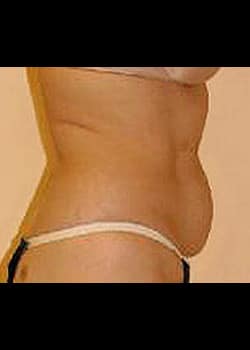 Liposuction Case 10