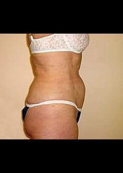 Liposuction Case 11